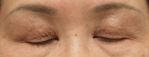眼瞼下垂術前。目を閉じた時の写真。