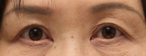 眼瞼下垂術後の写真。正面視