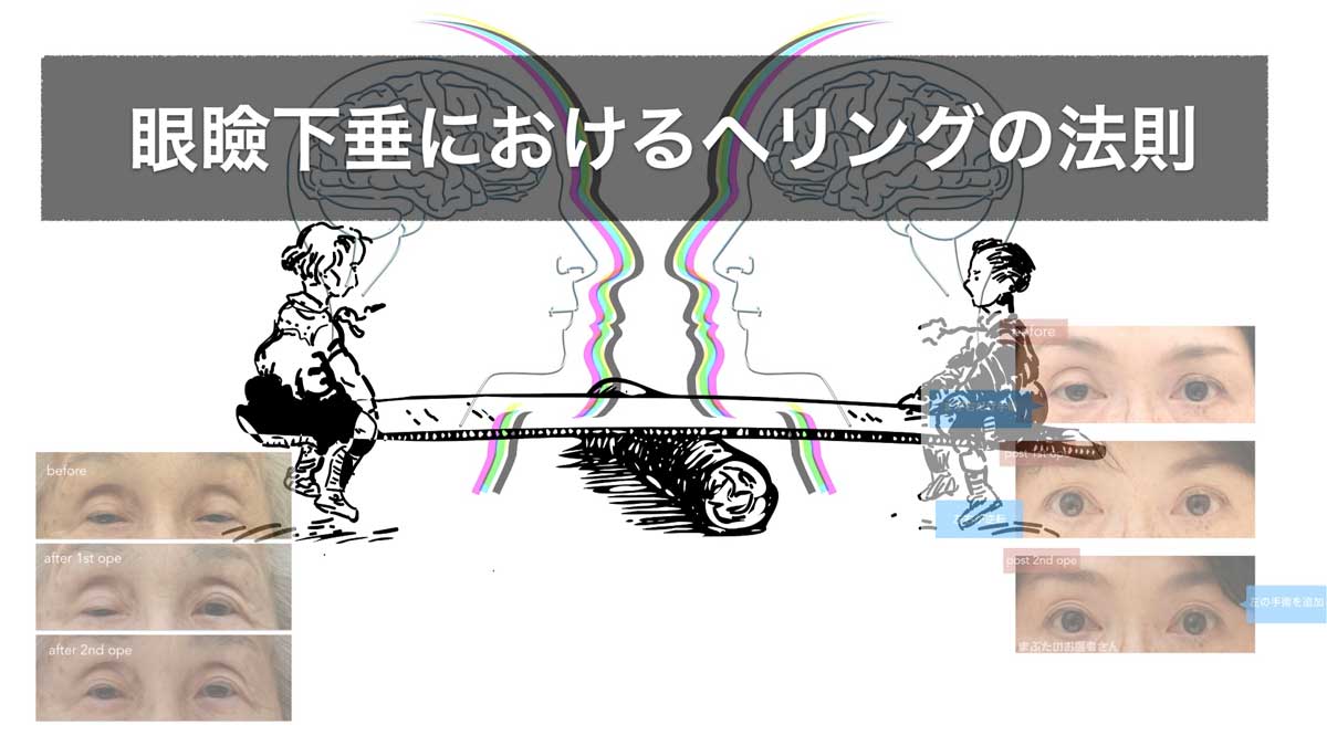 眼瞼下垂におけるヘリングの法則