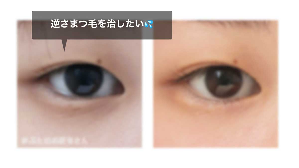 逆さまつ毛の治療後