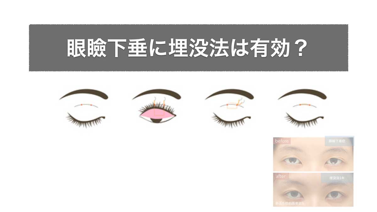 アイキャッチ　眼瞼下垂に埋没法は有効か？