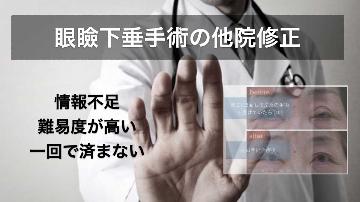 眼瞼下垂の他院修正