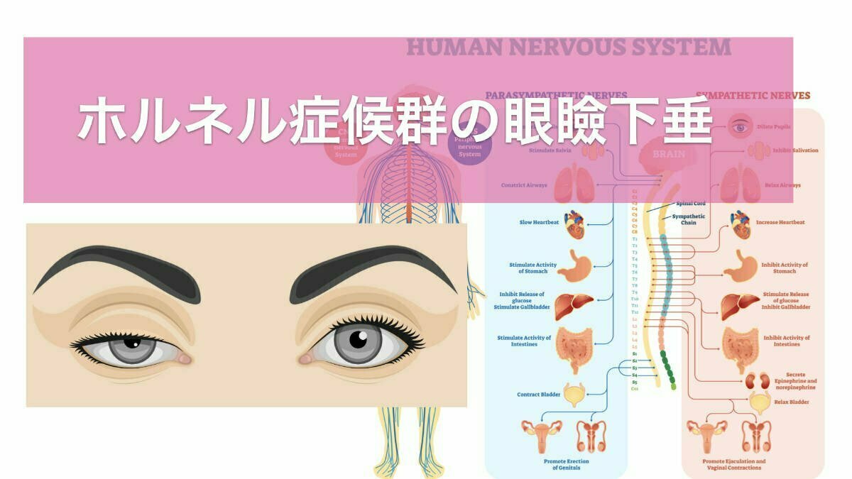 ホルネル症候群の眼瞼下垂