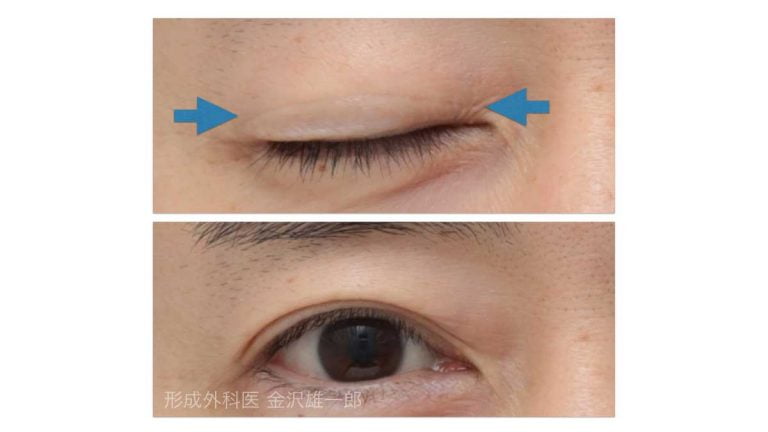 眼瞼下垂症手術でまぶたにケロイドができるか まぶたのお医者さん 眼瞼下垂専門の形成外科医
