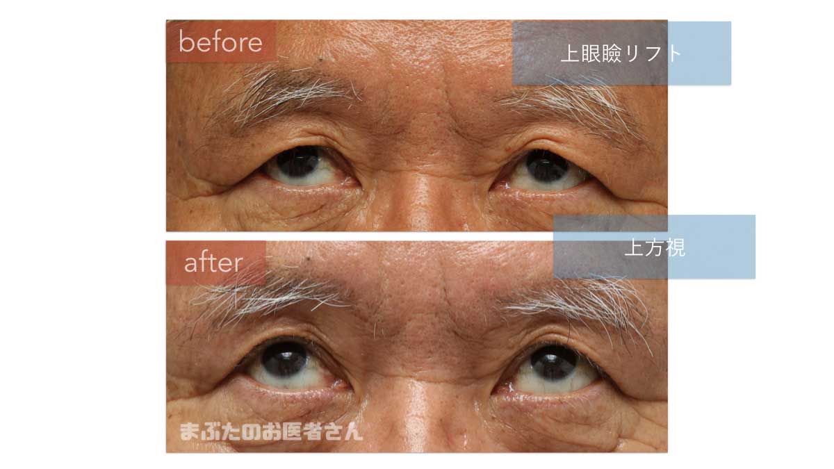 完全版 上眼瞼リフト 眉下切開 の適応 利点 欠点を4人のモデルケースと共に解説
