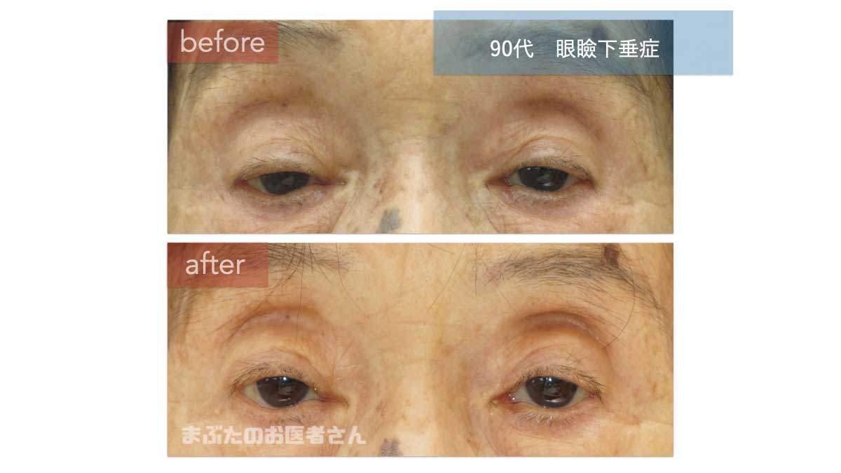 90代の眼瞼下垂