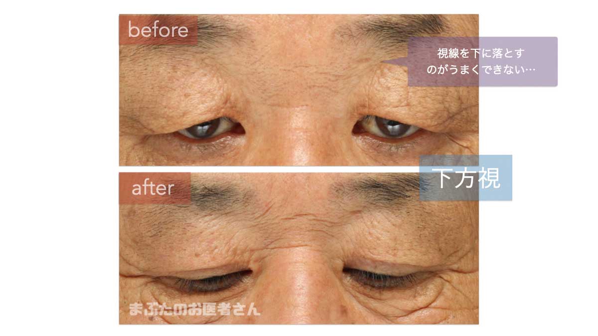 偽性眼瞼下垂下方視
