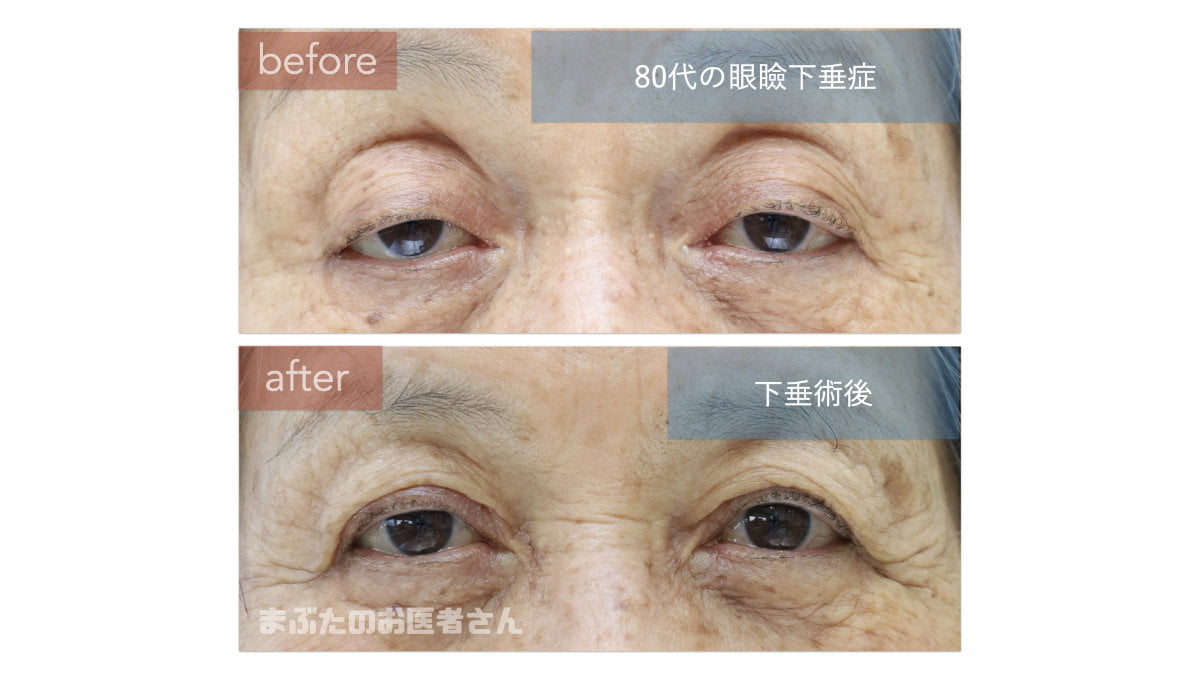 高齢者の眼瞼下垂手術