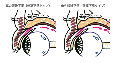 前葉下垂と後葉下垂アニメ