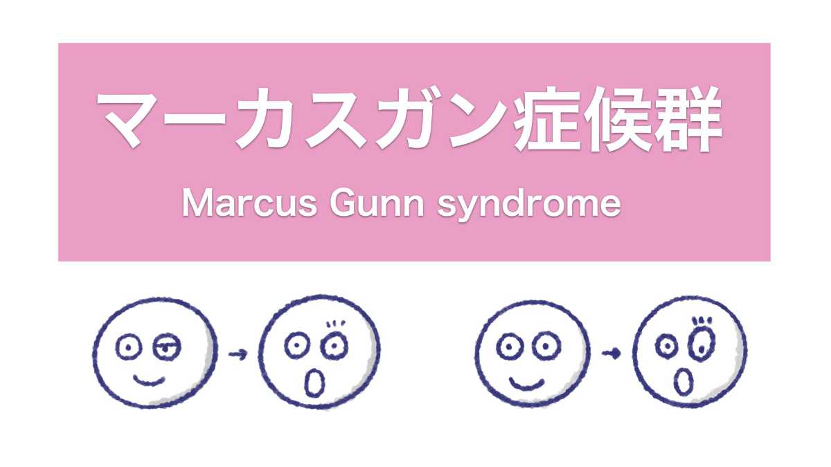 マーカスガン現症候群