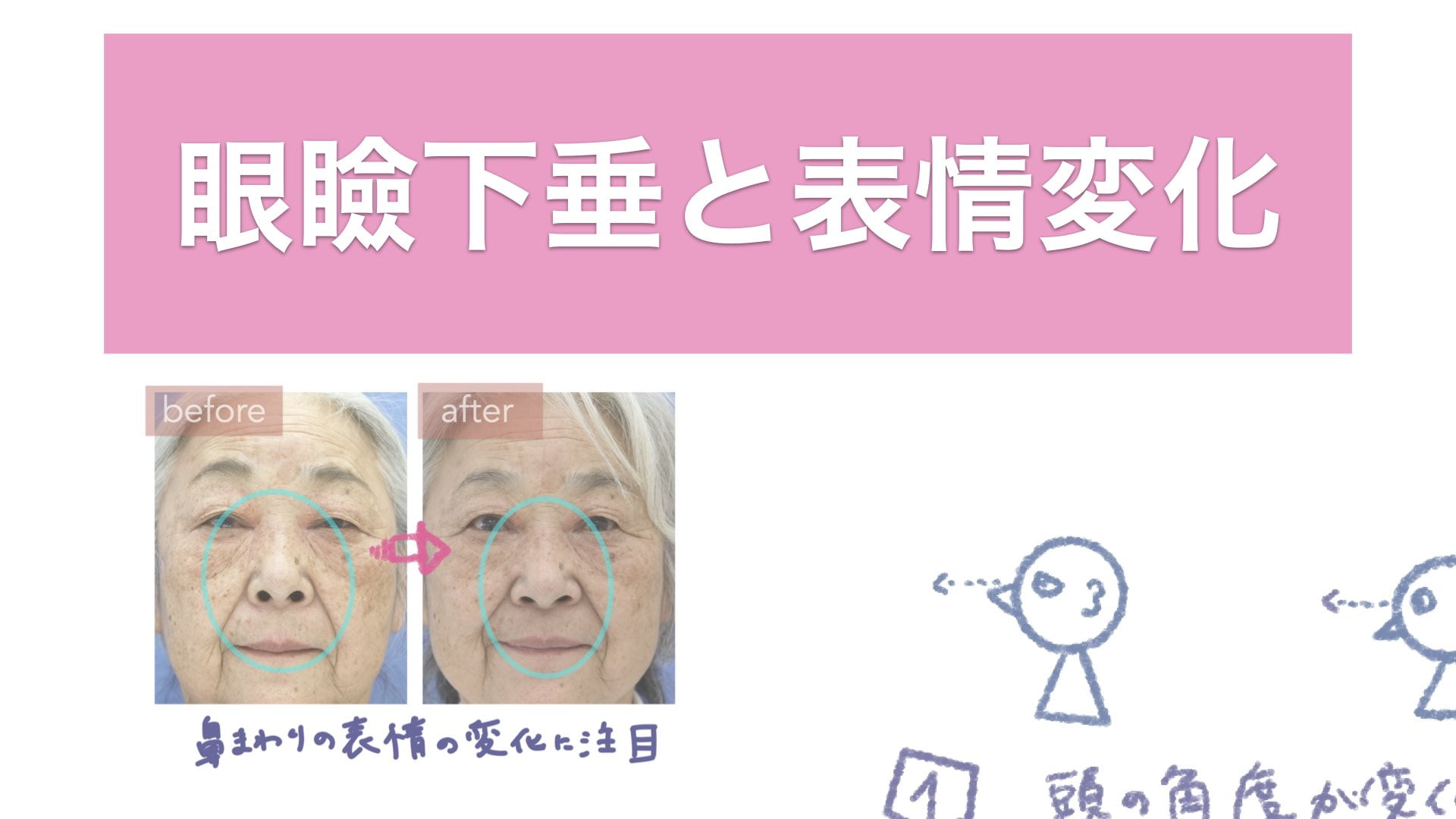 眼瞼下垂と表情変化