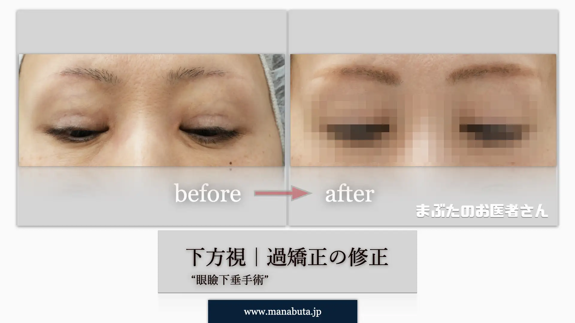 過大開瞼下方視 モザイク入り