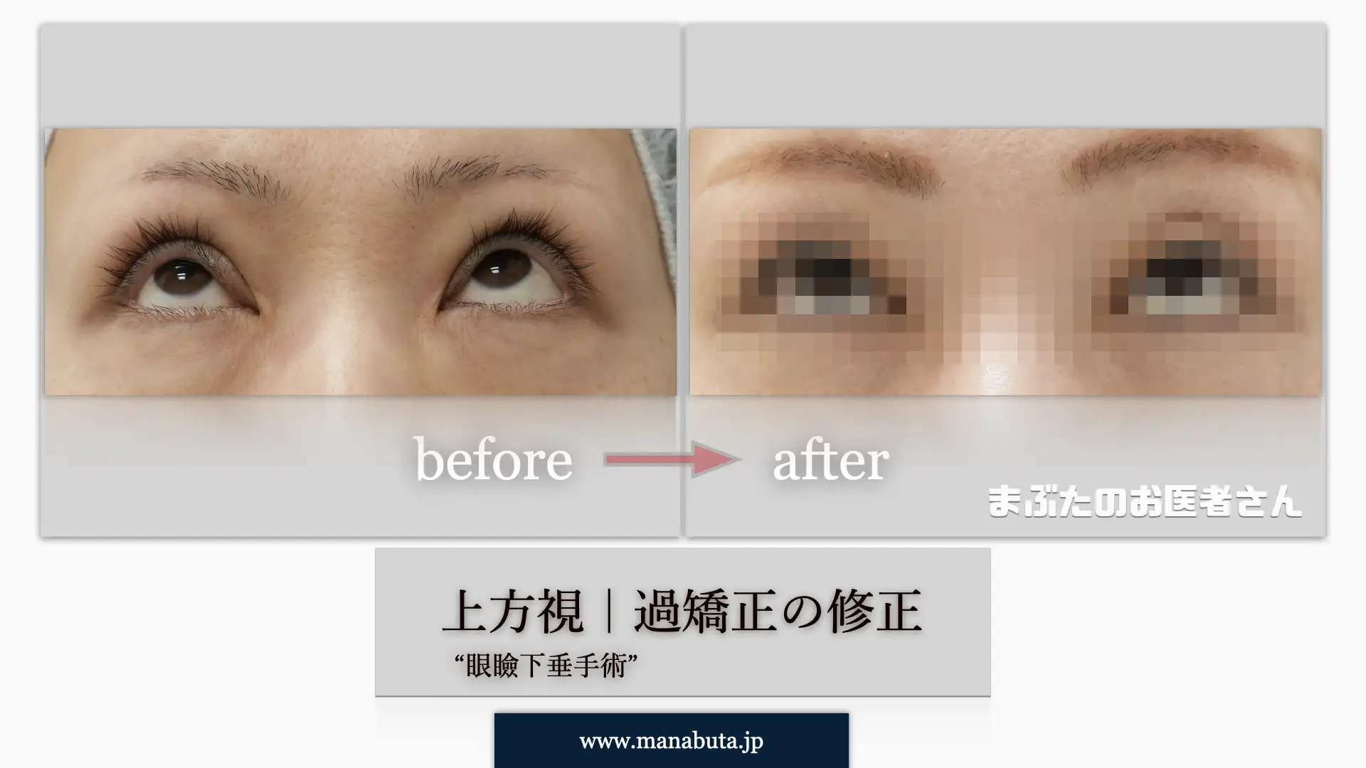 過矯正 上方視 モザイク