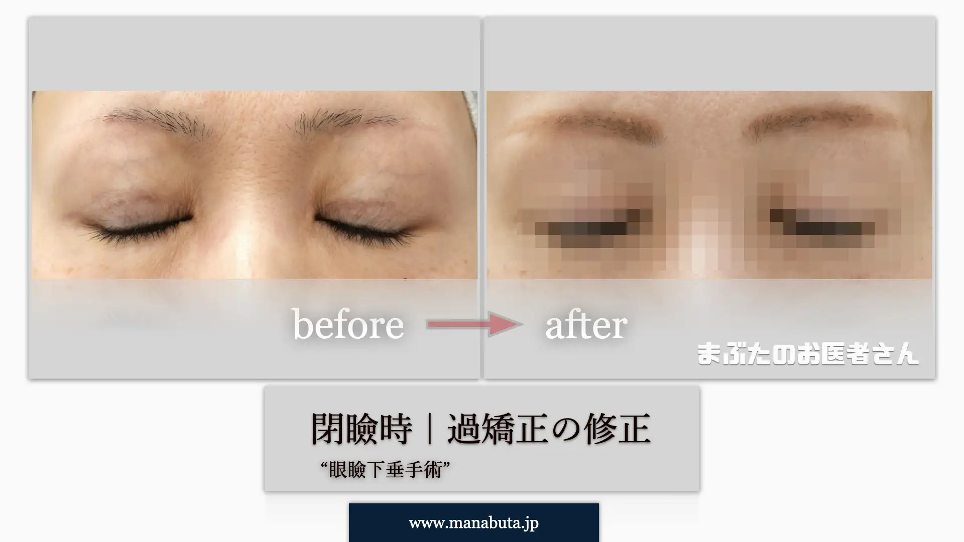 過大開瞼 閉瞼時 モザイク
