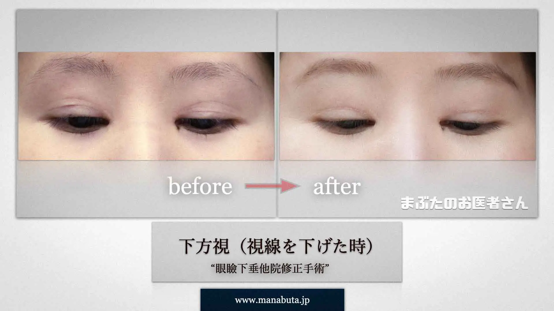 二重のラインの修正