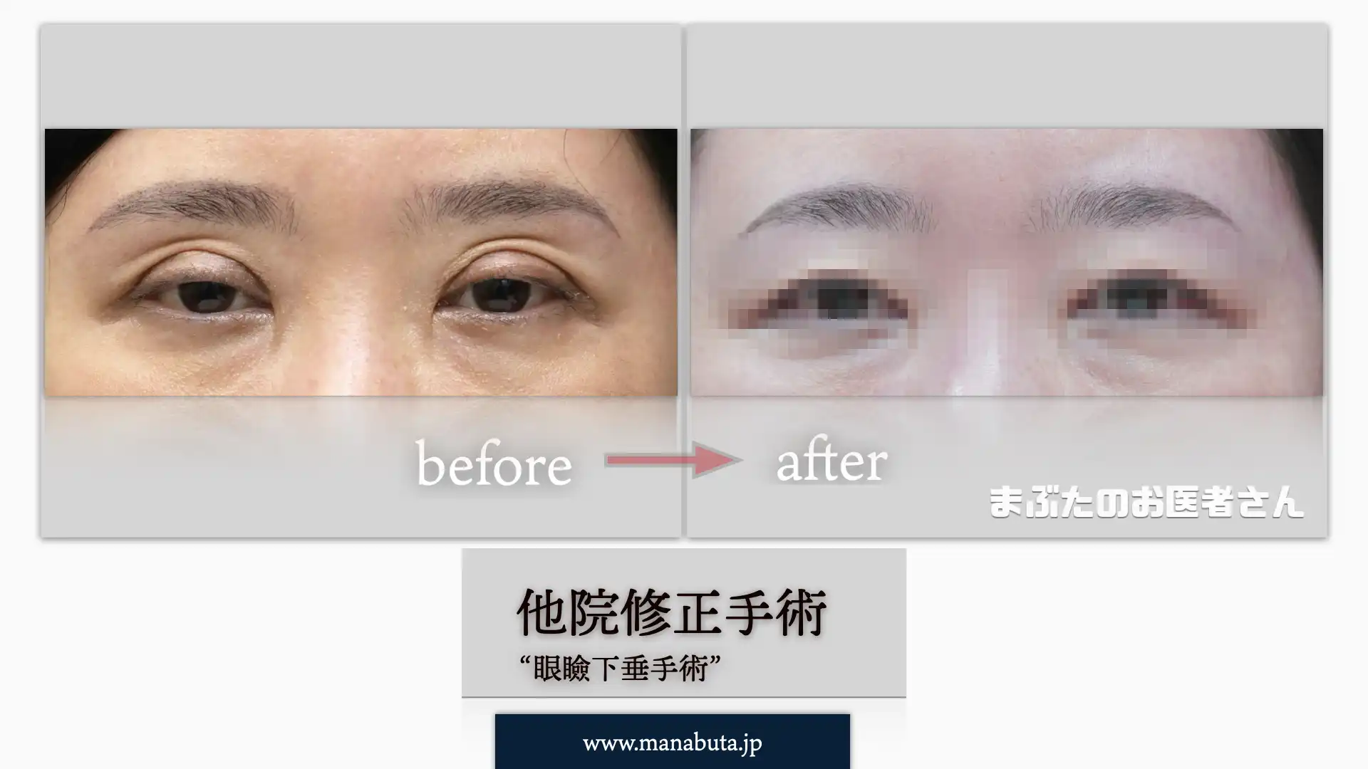 眼瞼下垂他院修正