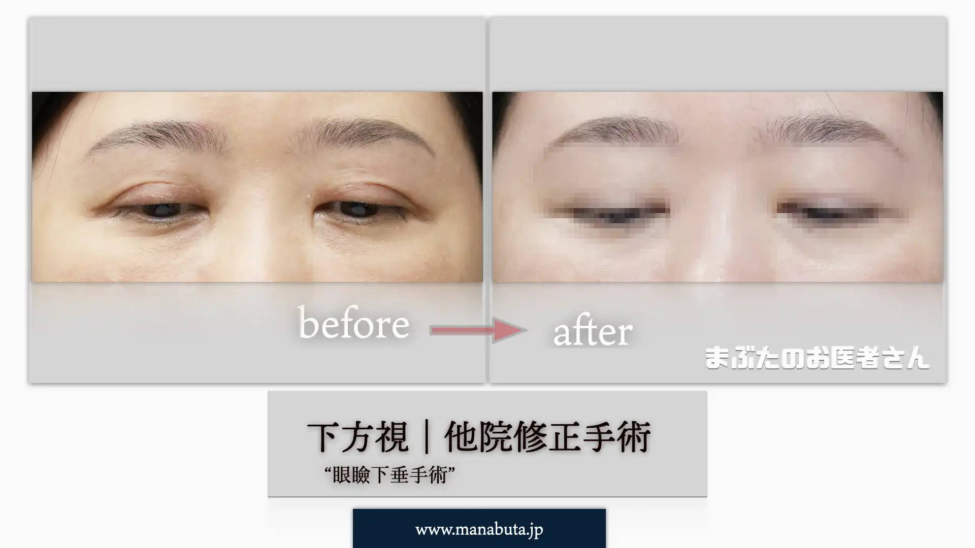 眼瞼下垂、他院修正