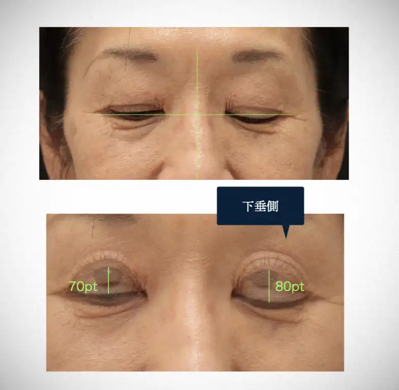 挙筋機能測定の矛盾現象